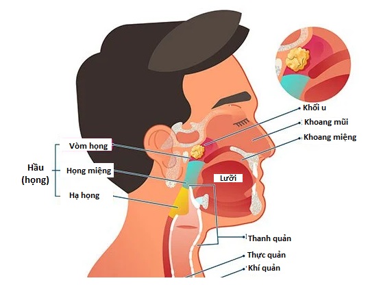 Ung thư vòm mũi họng - Nguyên nhân, chẩn đoán và phác đồ điều trị